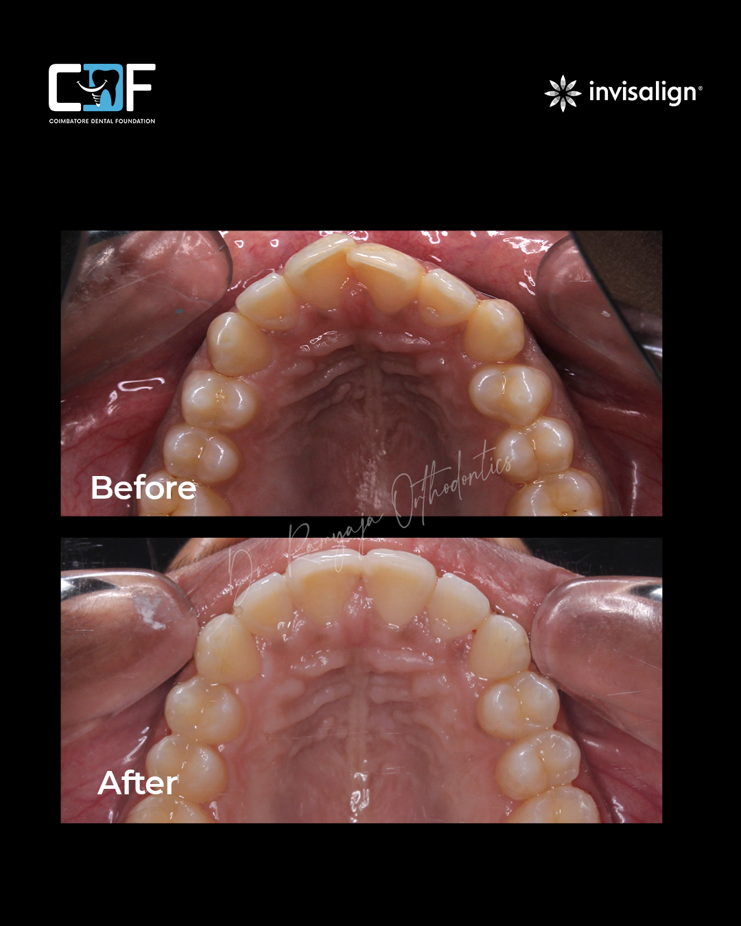 Before After Result